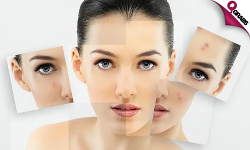 Acne Therapy Sessions!